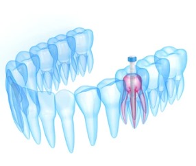 Post-and-core-therapy Post And Core Therapy