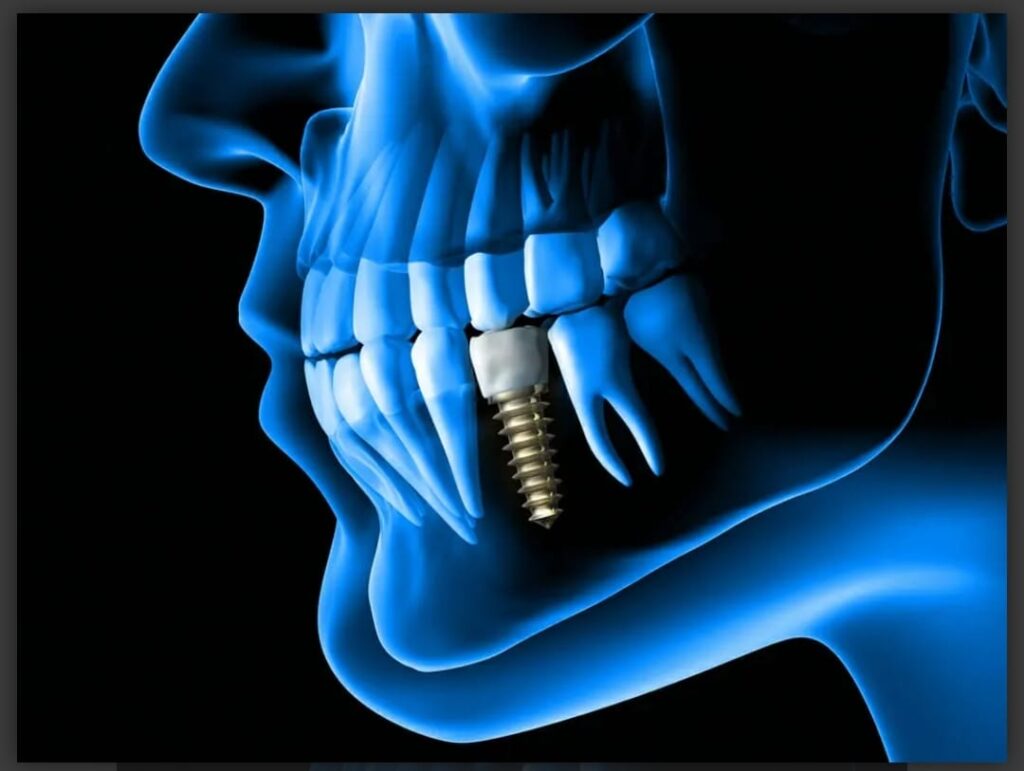 dental-implant-1024x771 Dental Implant 1024x771 1